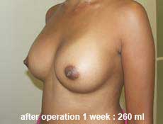 plastic-surgery-breast-augmentation 